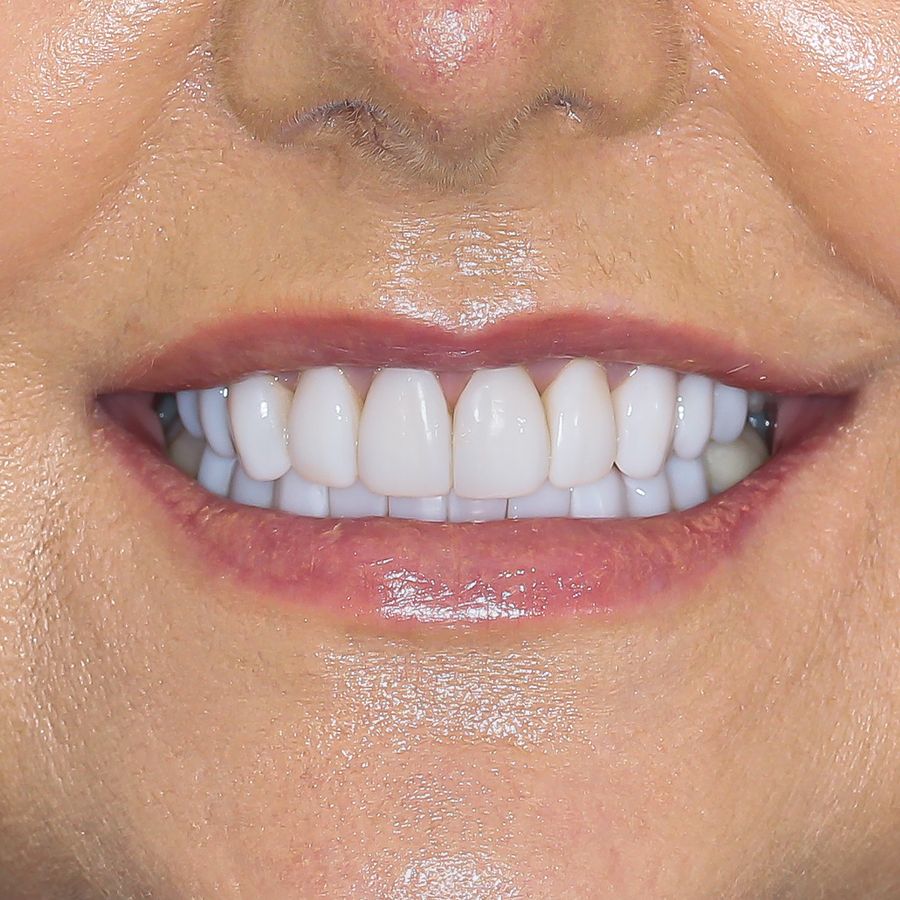 composite veneers after 3Dental